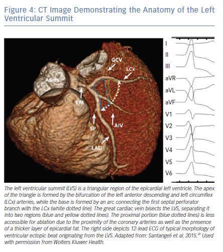 lv summit|left ventricular summit.